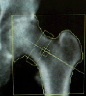 bone density scan